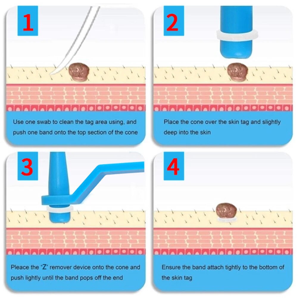 Skin Tag Removal Kit - 2-in-1 Silicone Band Ligation System for Safe Home Use