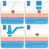 Skin Tag Removal Kit - 2-in-1 Silicone Band Ligation System for Safe Home Use